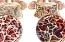 世界杯买球软件 -强烈建(jiàn)議(yì)骨质疏松的人多(duō)运动力量訓(xùn)练和平(píng)衡訓(xùn)练的多(duō)模式(shì)訓(xùn)练方(fāng)案。原(yuán)因(yīn)很(hěn)简單(dān)：骨骼、肌肉、姿(zī)勢(shì)控制和跌倒風(fēng)险并非孤立存在，而是密切相關(guān)。