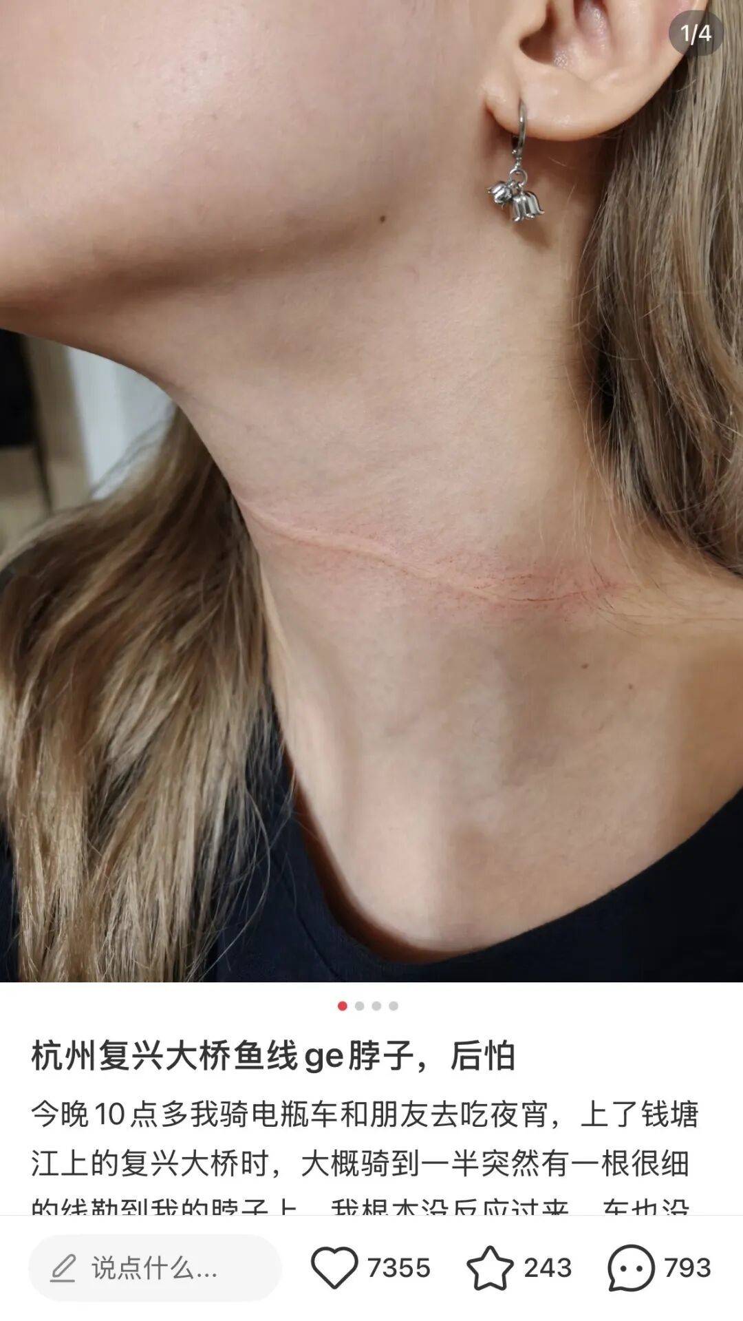 “真的后怕,根本反应不过来,线越勒越紧”,一女子夜骑,突然被细线勒住脖颈……